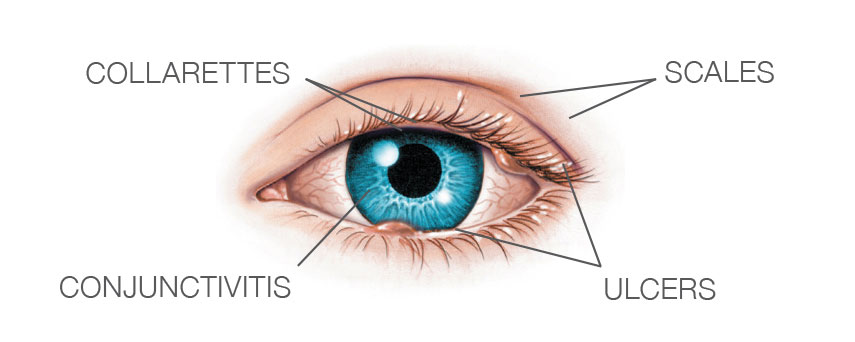 Dry eyes causes