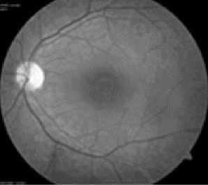 Macular hole
