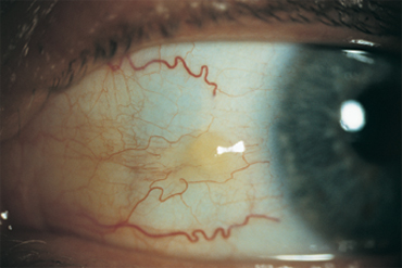 Pinguecula (Yellow Bump on Eyeball): Diagnosis, Causes & Treatment