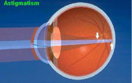 Astigmatism vision