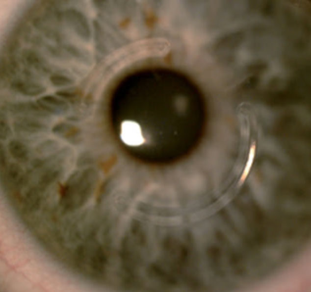 Conreal implants on eye