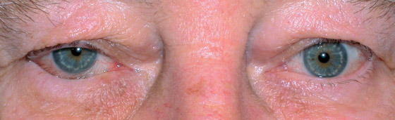 After ectropion repair surgery