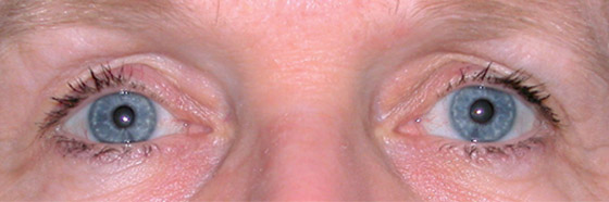 After ptosis surgery