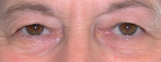 Before blepharoplasty surgery