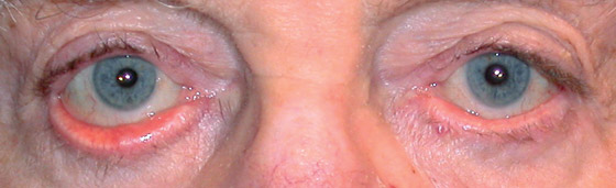 Before ectropion repair surgery