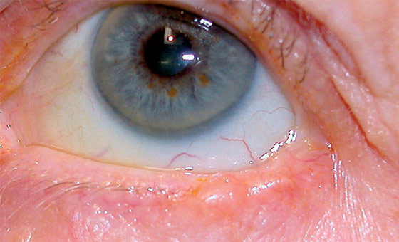 Eyelid and facial skin tumours