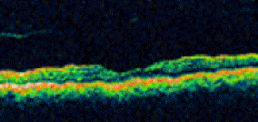 Macular hole after surgery
