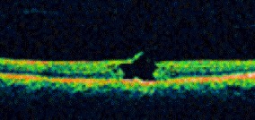 Macular hole before surgery