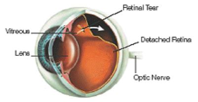 Retinal tear