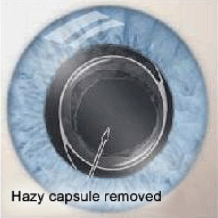 Post-op YAG laser capsulotomy