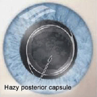 Posterior capsule opacity